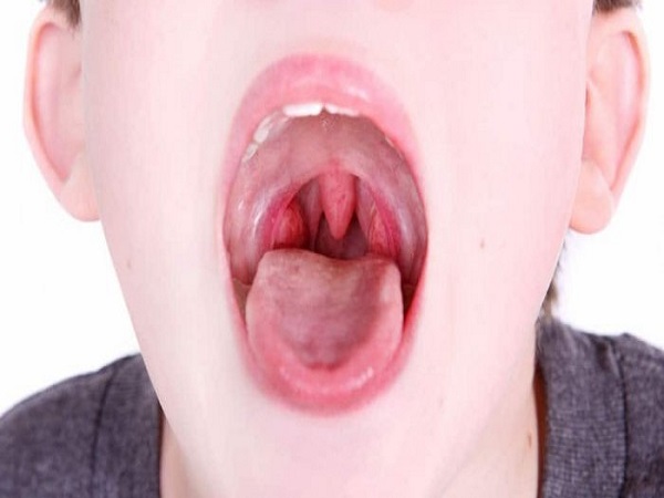 Viêm họng cấp là gì?